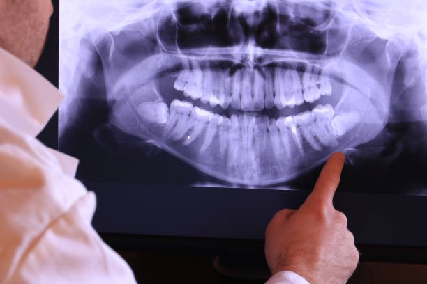 Best Knocked-Out Tooth (Avulsed Tooth) Treatment in Tusculum, TN
